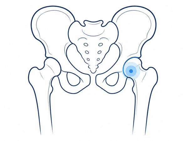 Hip and Pelvic Bone Tumor