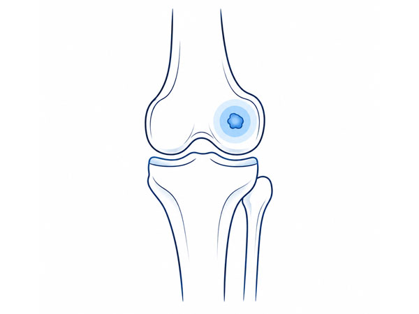 Knee Bone Tumor