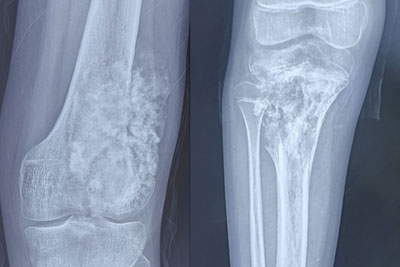 Osteosarcoma