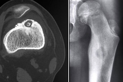 Other Bone Tumors