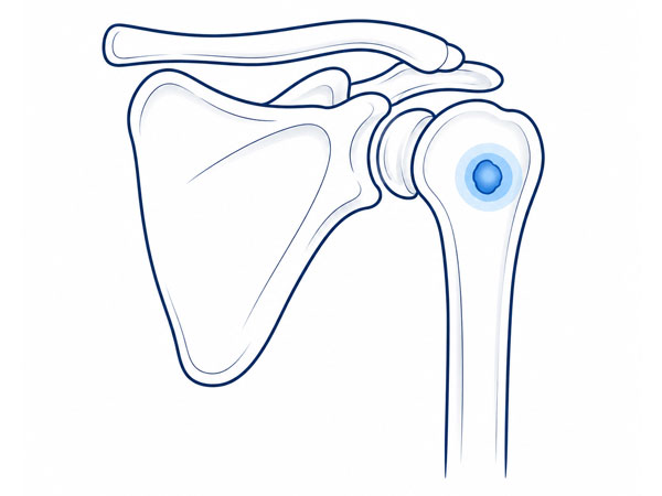 Shoulder Bone Tumor