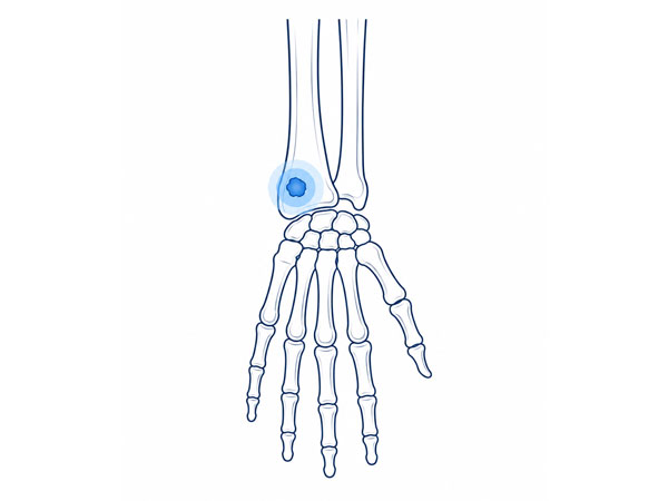 Hand and Wrist Bone Tumors