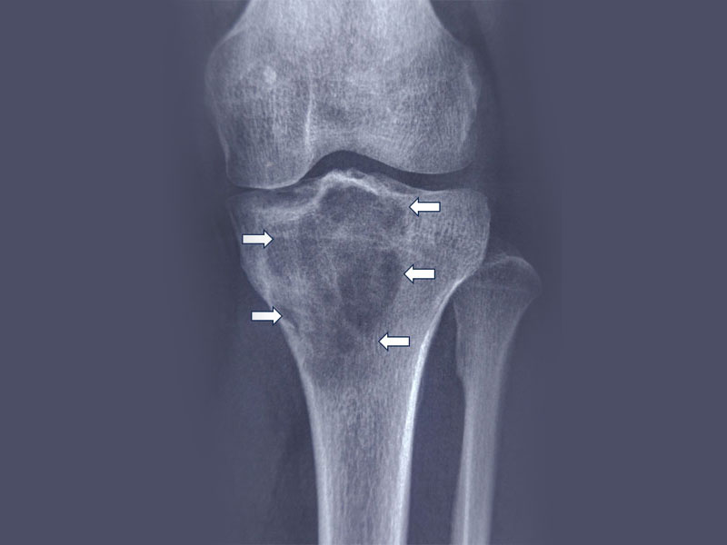 Giant Cell Tumor of Bone: Symptoms, Causes and Who Is at Risk?